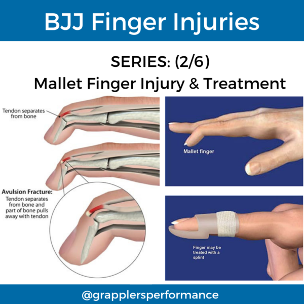 Common BJJ Finger Injuries Part 2 Grapplers Performance