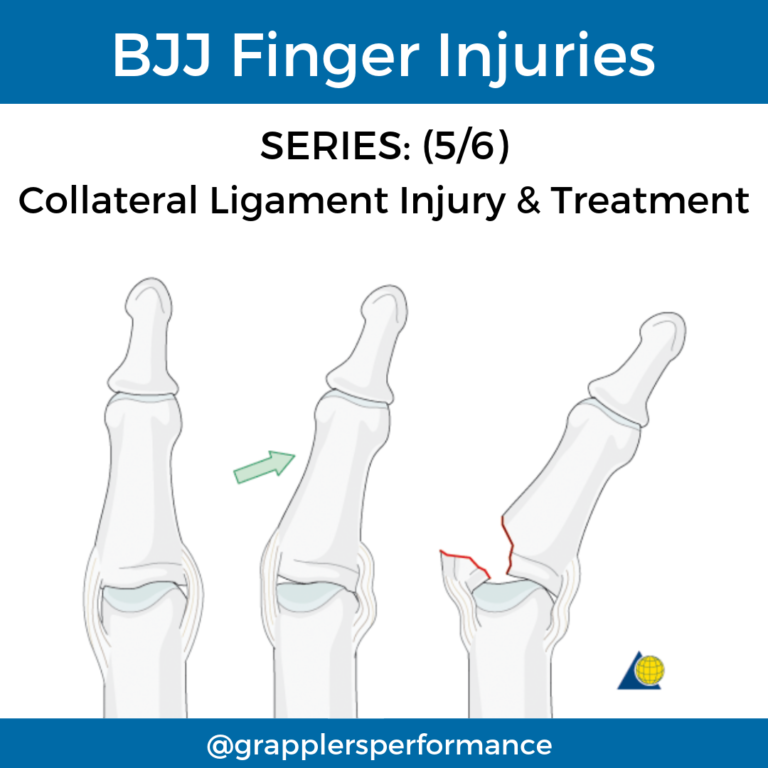 BJJ Finger Injury: Collateral Ligament Injury Finger Grapplers Performance
