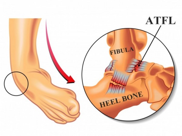 BJJ Ligament Injury