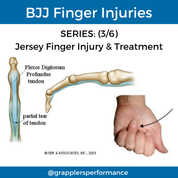 Common BJJ Finger Injuries: Part 2 - Grapplers Performance